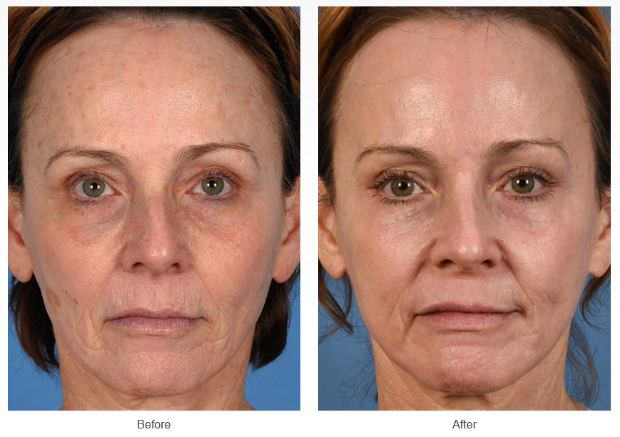 Before and After Photos Laser Treatments Case #313