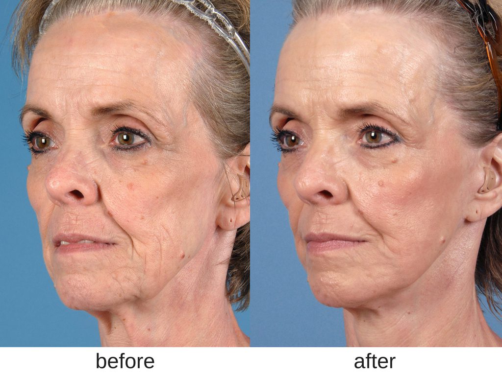 Facelift before and after. 