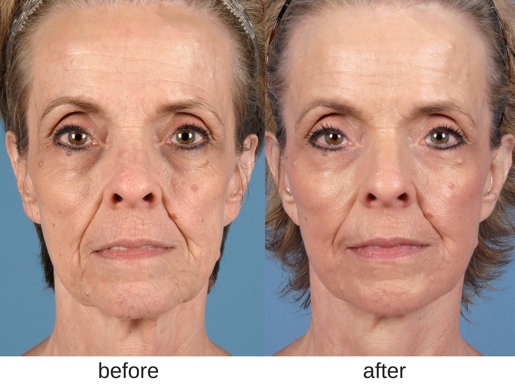 Facelift before and after.