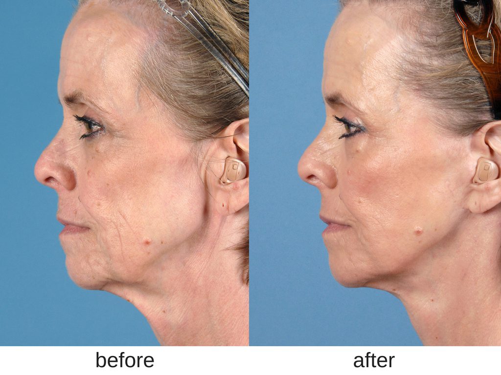 Facelift before and after. 