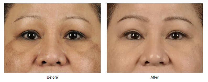 Eyelid Surgery Case 285
