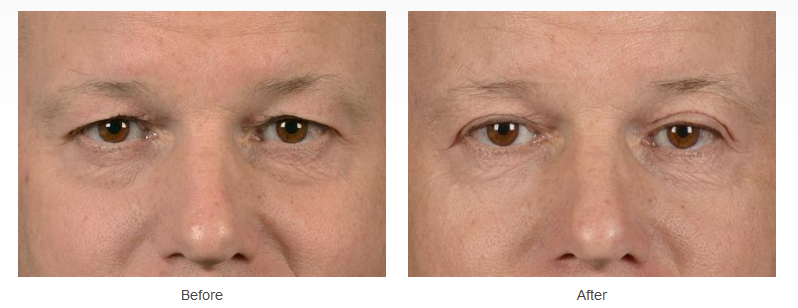 Eyelid Surgery Case 38