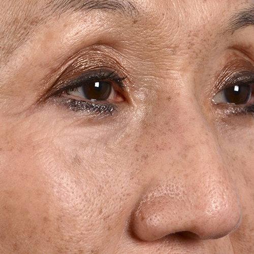 Normal-Combination + Photo-Damaged Skin