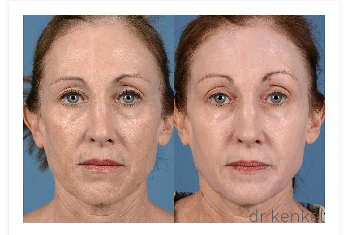 Laser Skin Resurfacing Case #295