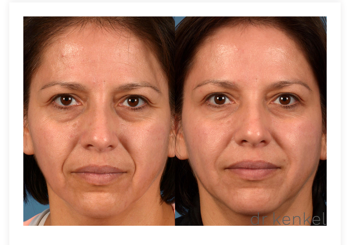 Injectables Case #75