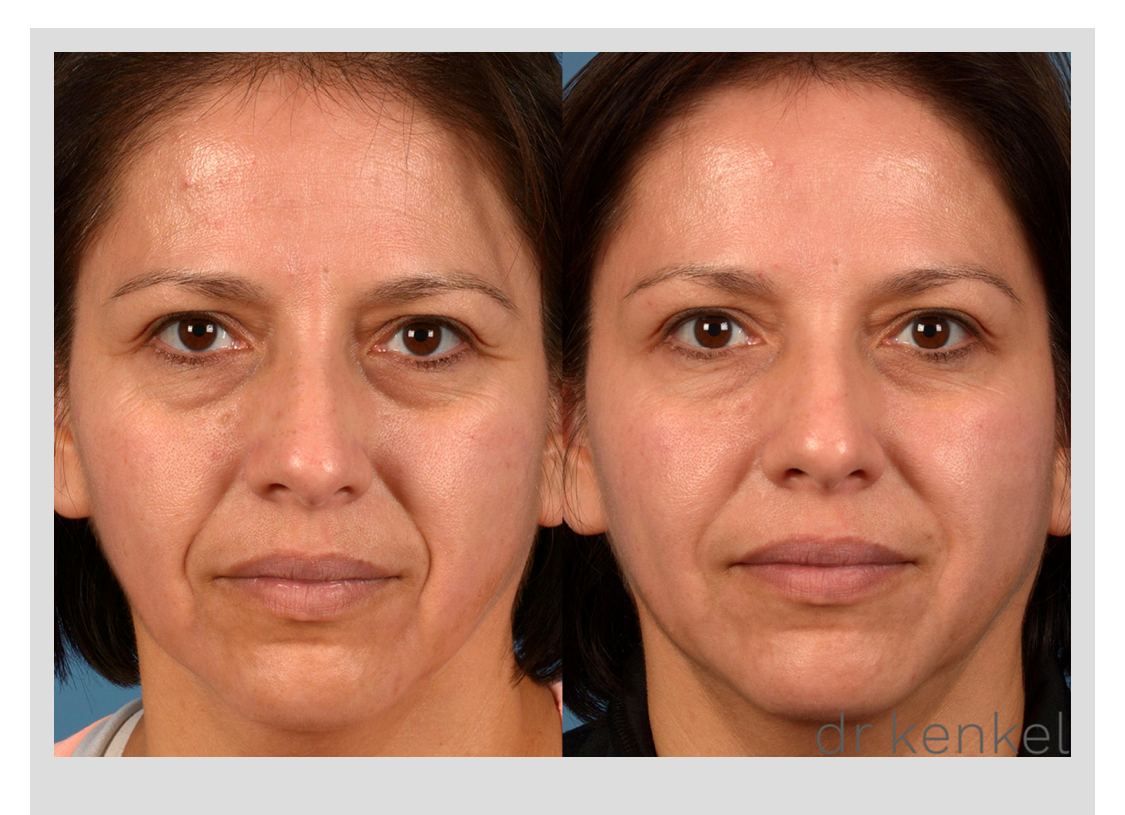 Injectables-Case-75
