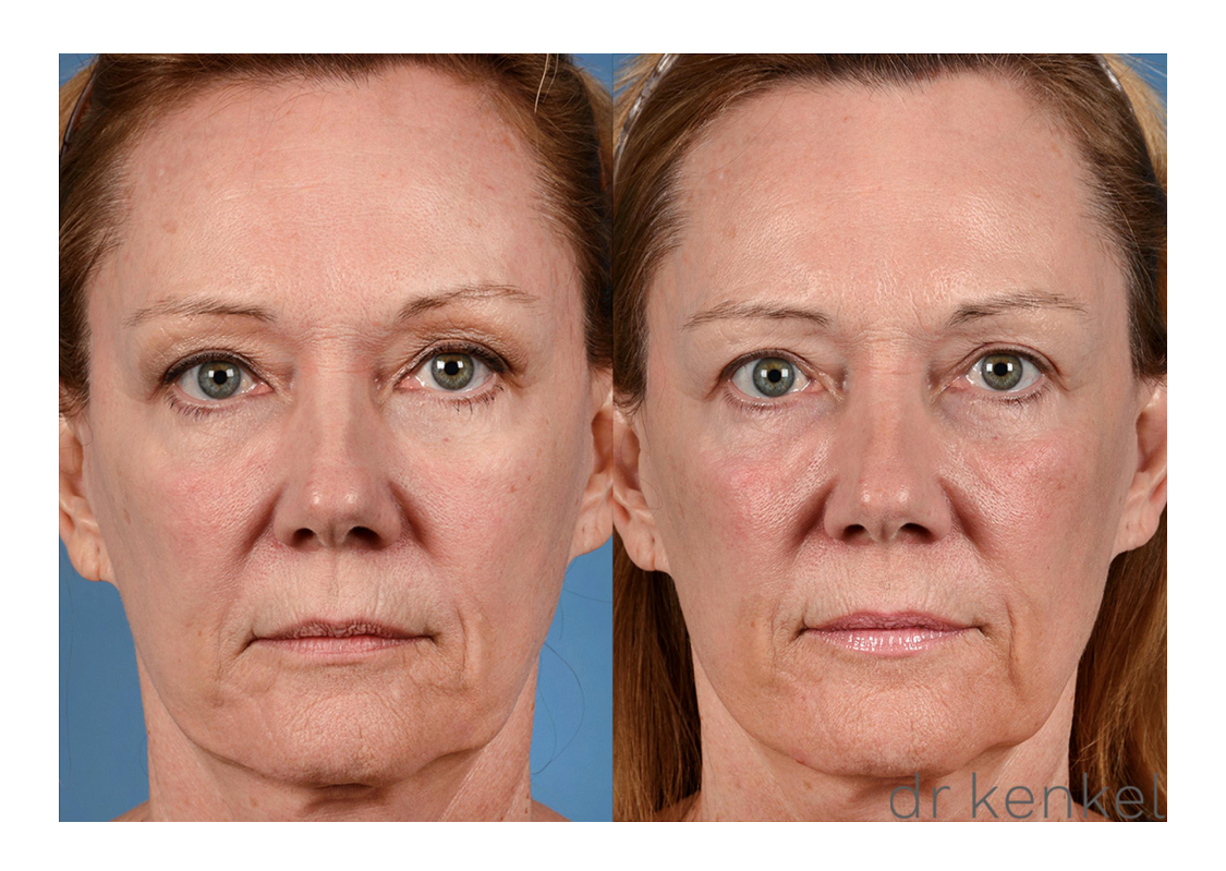 Laser Skin resurfacing Case #207 