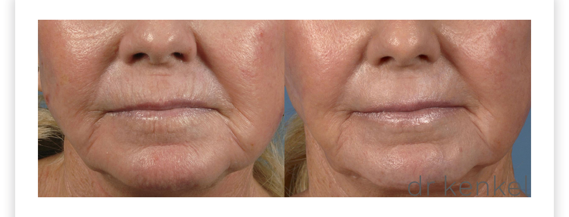 Laser Skin Resurfacing Case #151