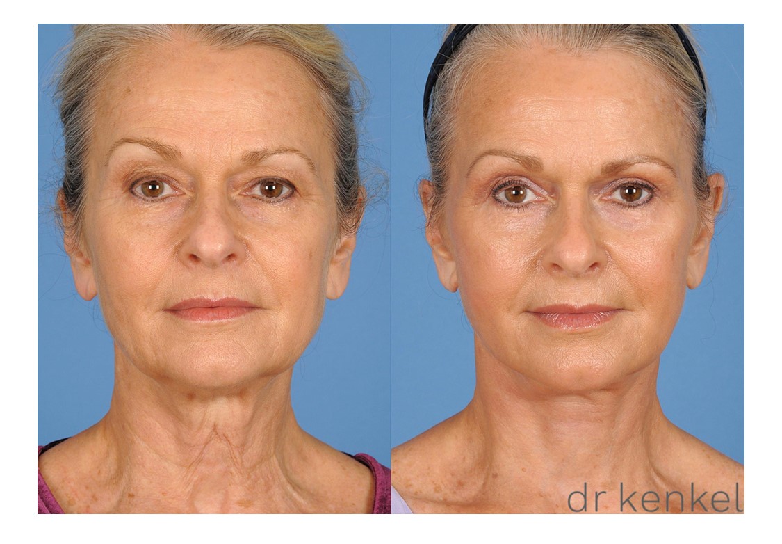 Facelift patient case #270 - front view