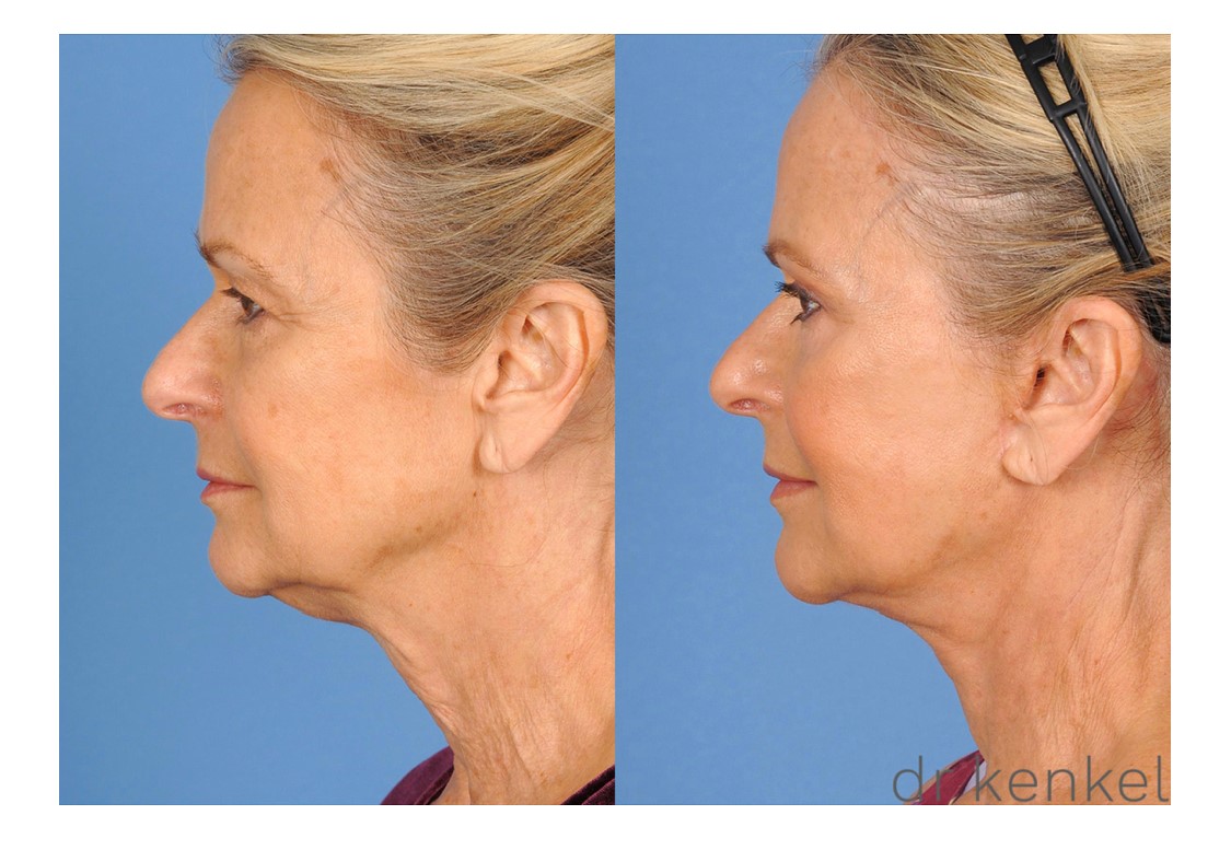 Facelift patient case #270 - side view