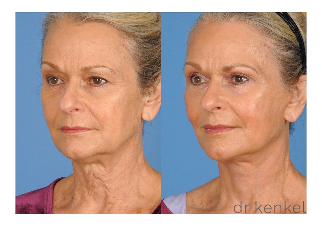 Facelift patient case #270 - oblique view