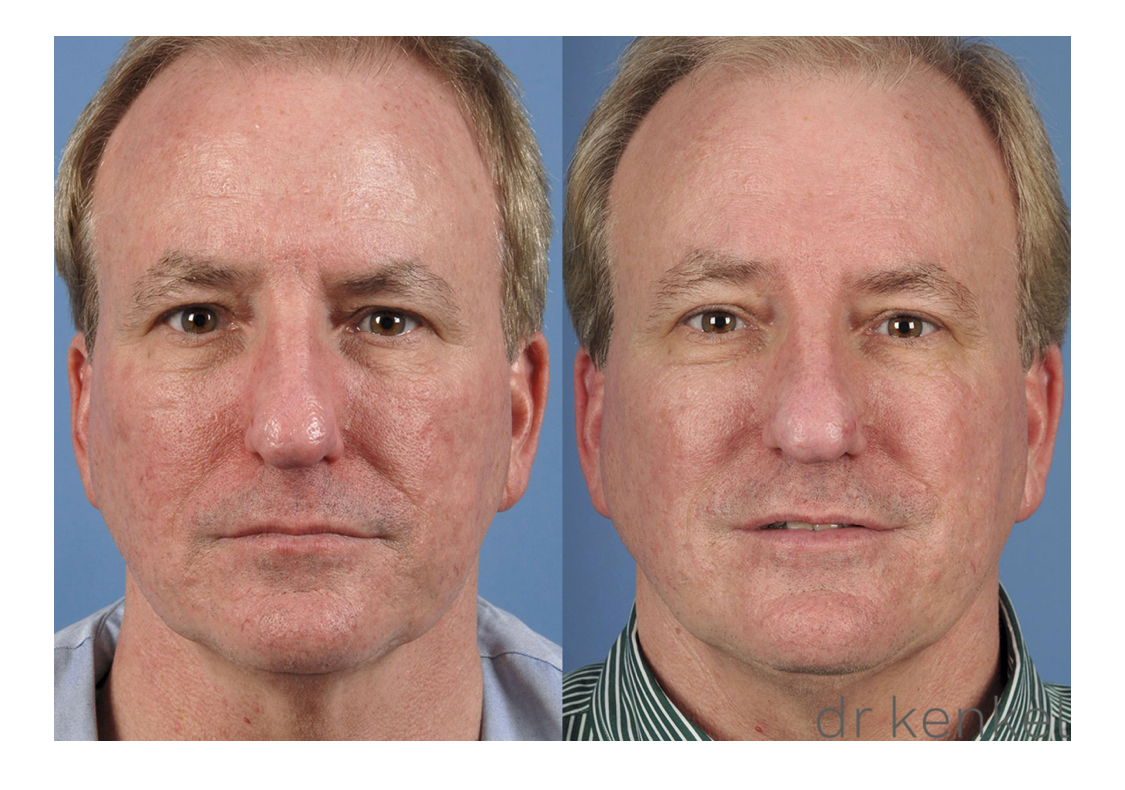 Laser skin resurfacing case #159 - front view