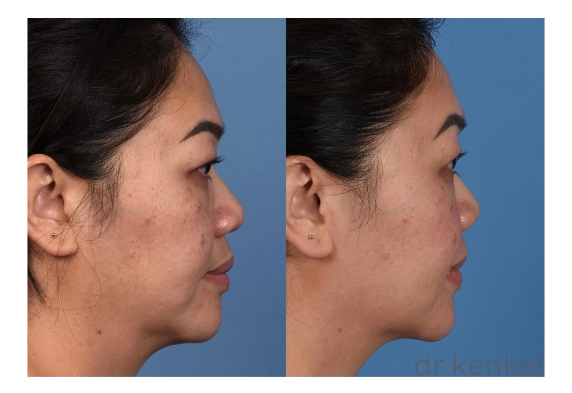 Laser treatments case #342 side view