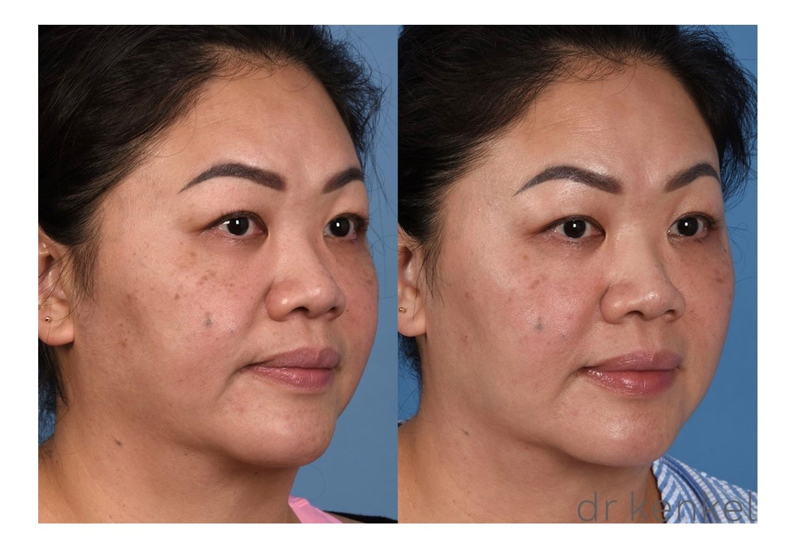 Laser treatments case #342 oblique view