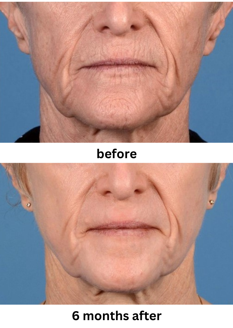 Laser skin resurfacing case #296 - front view close up