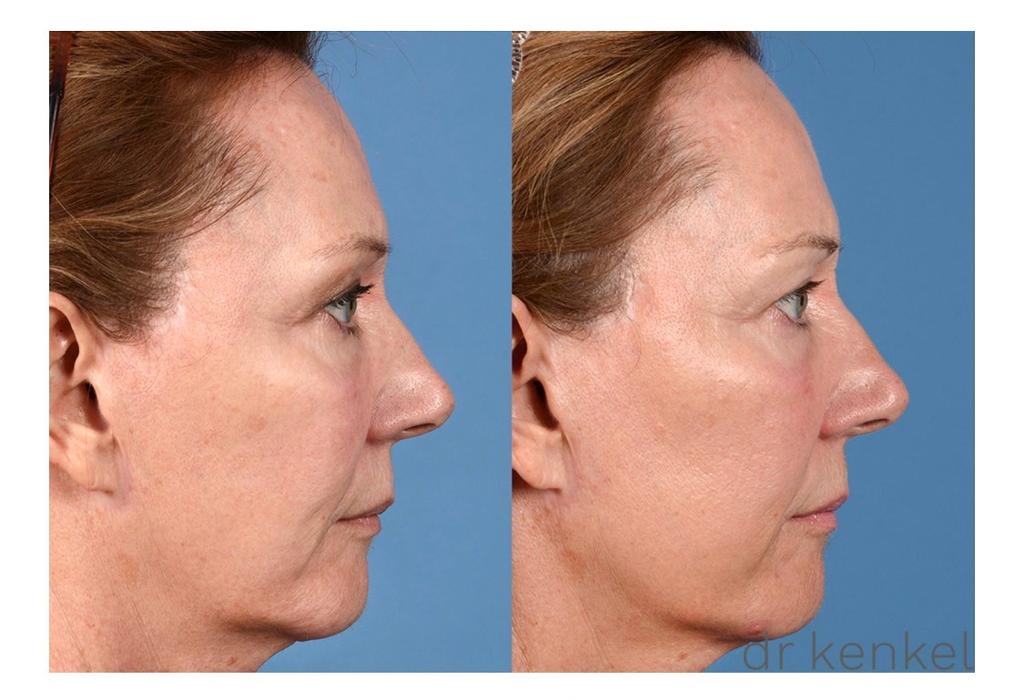 Laser skin resurfacing case #207 - side view