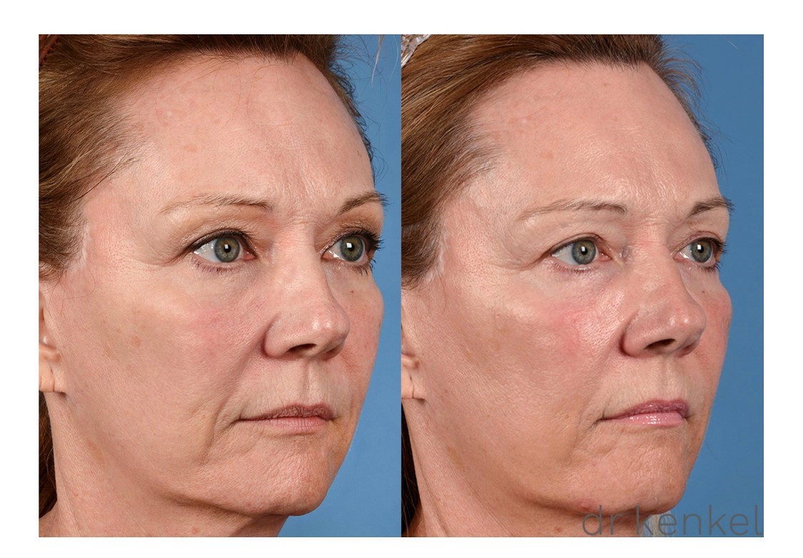 Laser skin resurfacing case #207 - oblique view