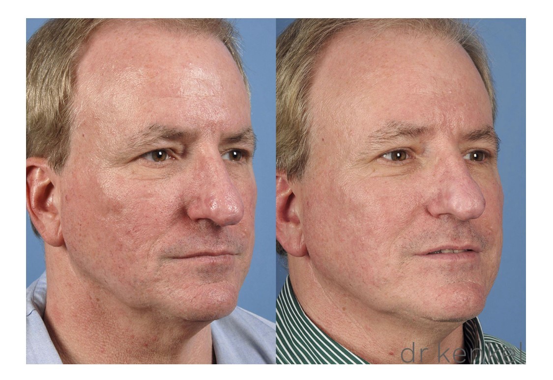 Laser skin resurfacing case #159 - oblique view