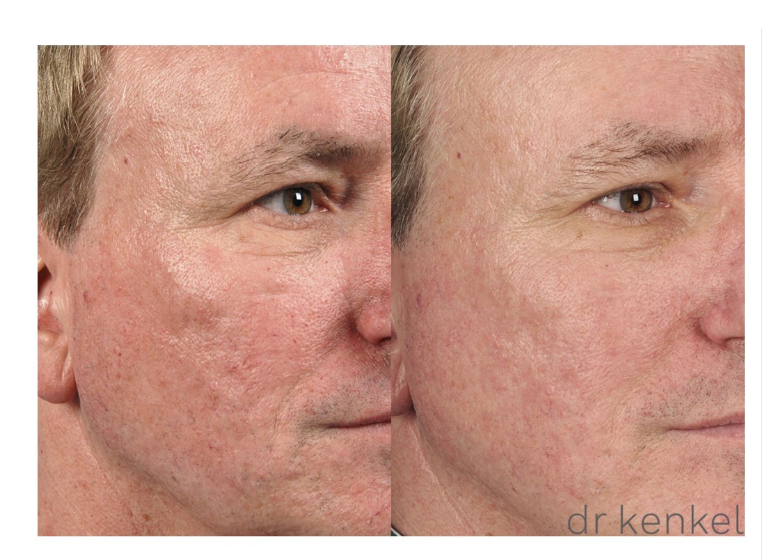Laser skin resurfacing case #159 - oblique view close up