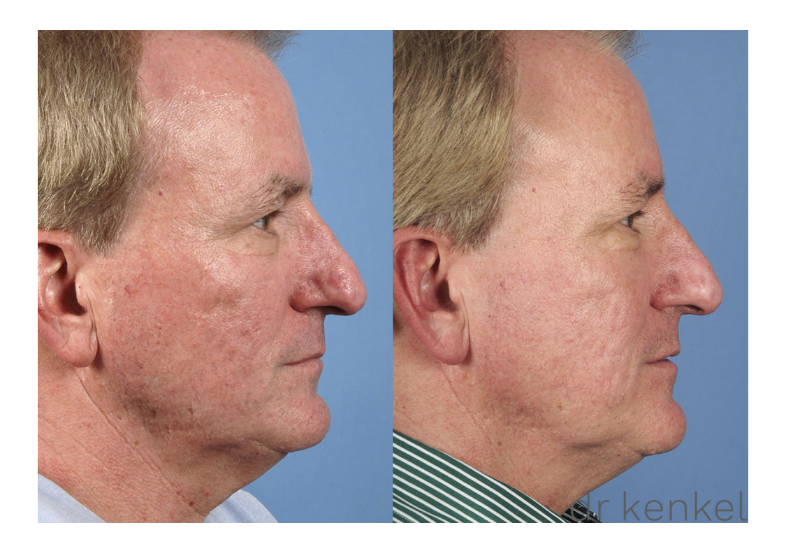 Laser skin resurfacing case #159 - side view