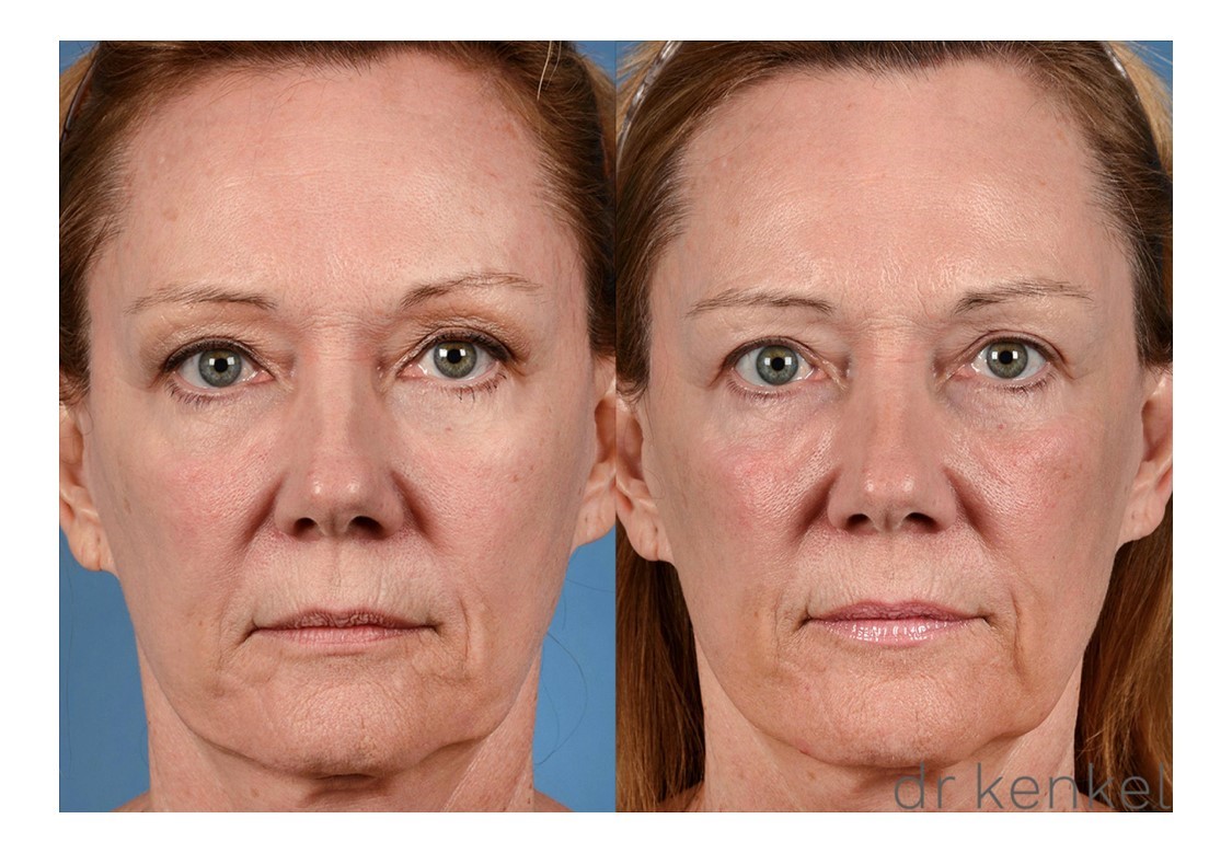 Laser skin resurfacing case #207 - front view