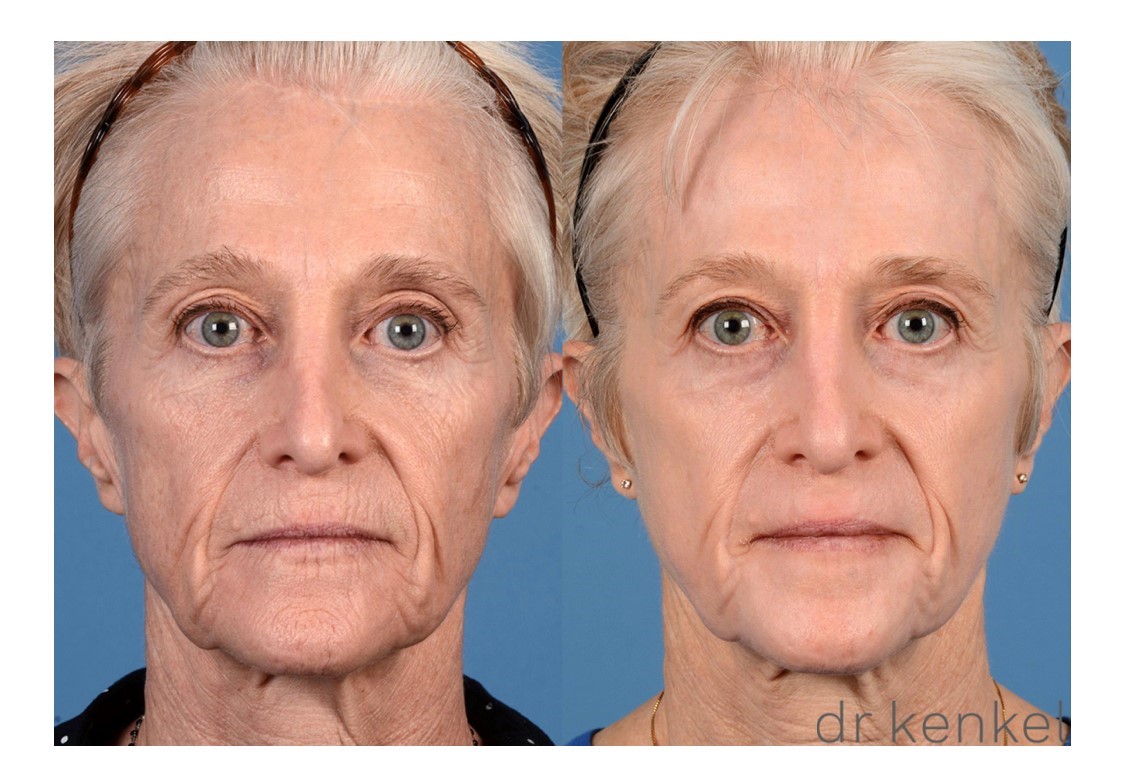 Laser skin resurfacing case #296 - front view