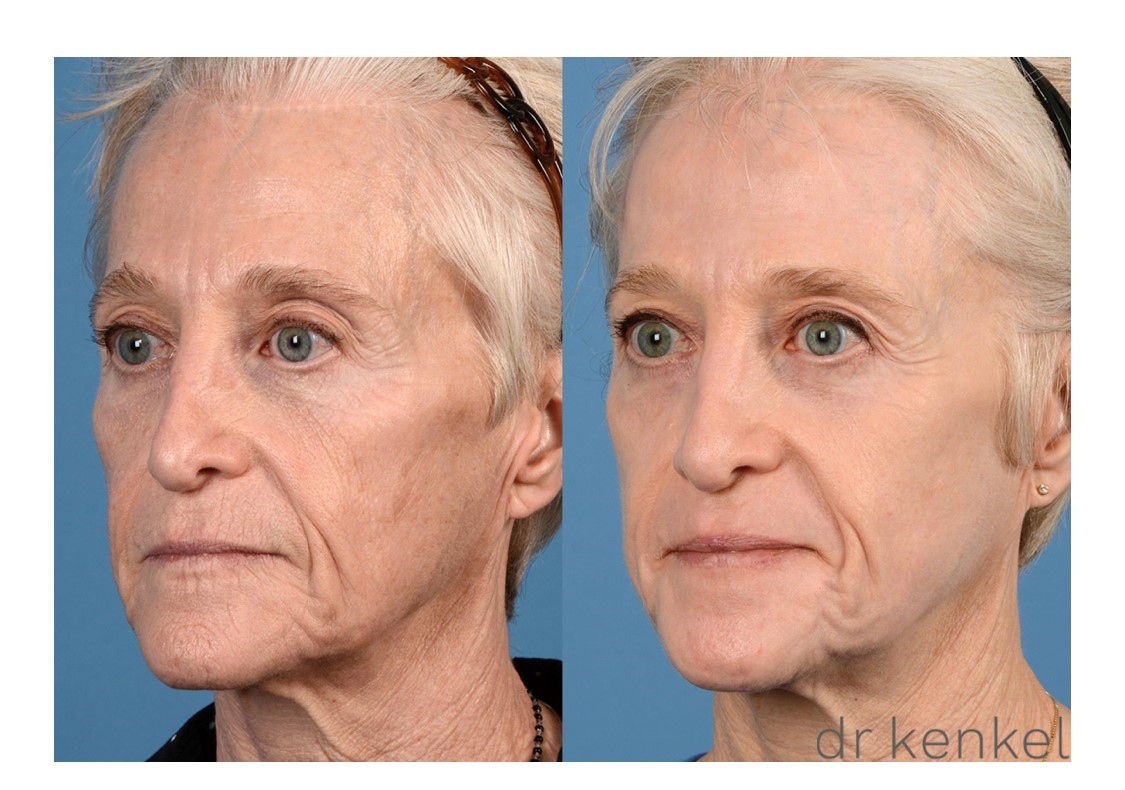 Laser skin resurfacing case #296 - oblique view