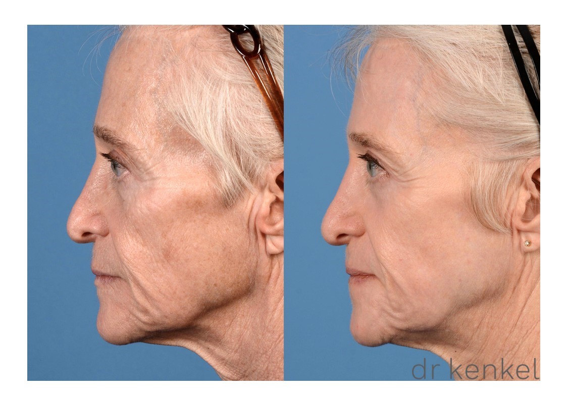 Laser skin resurfacing case #296 - side view