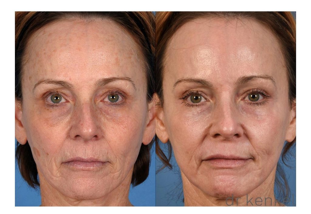 Laser treatments case #313 - front view