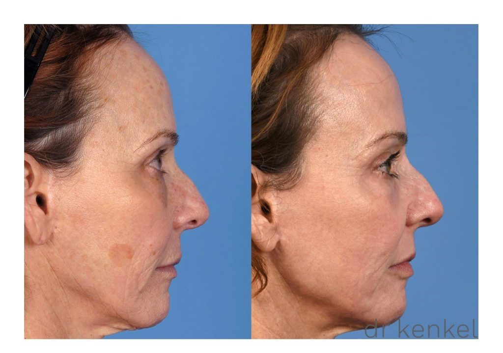 Laser treatments case #313 - side view