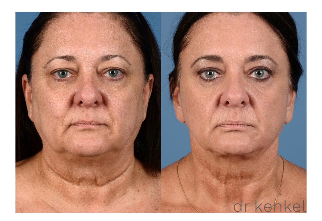 Facelift patient case #261 - front view