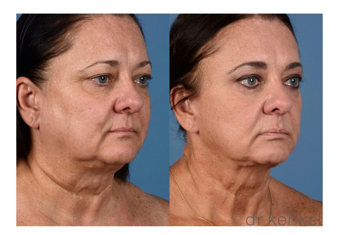 Facelift patient case #261 - oblique view