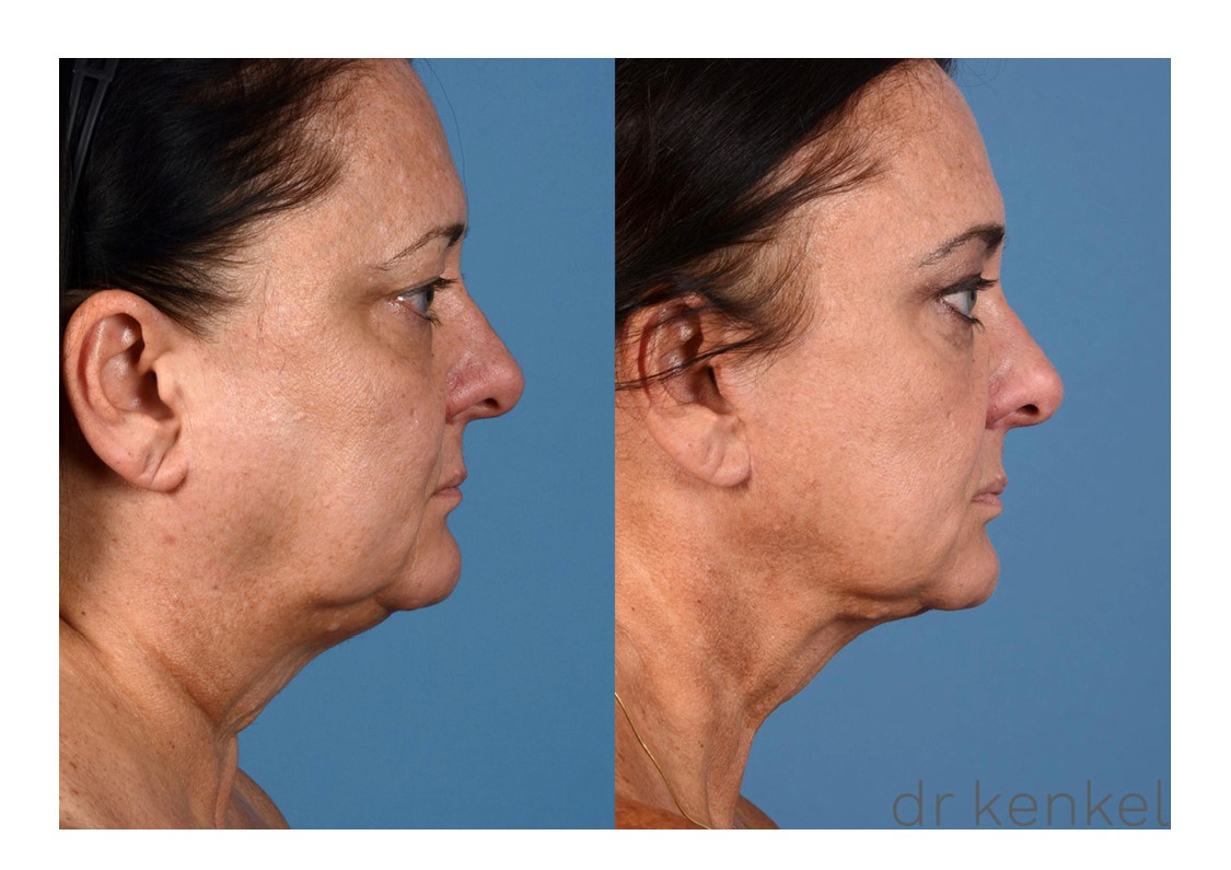 Facelift patient case #261 - side view