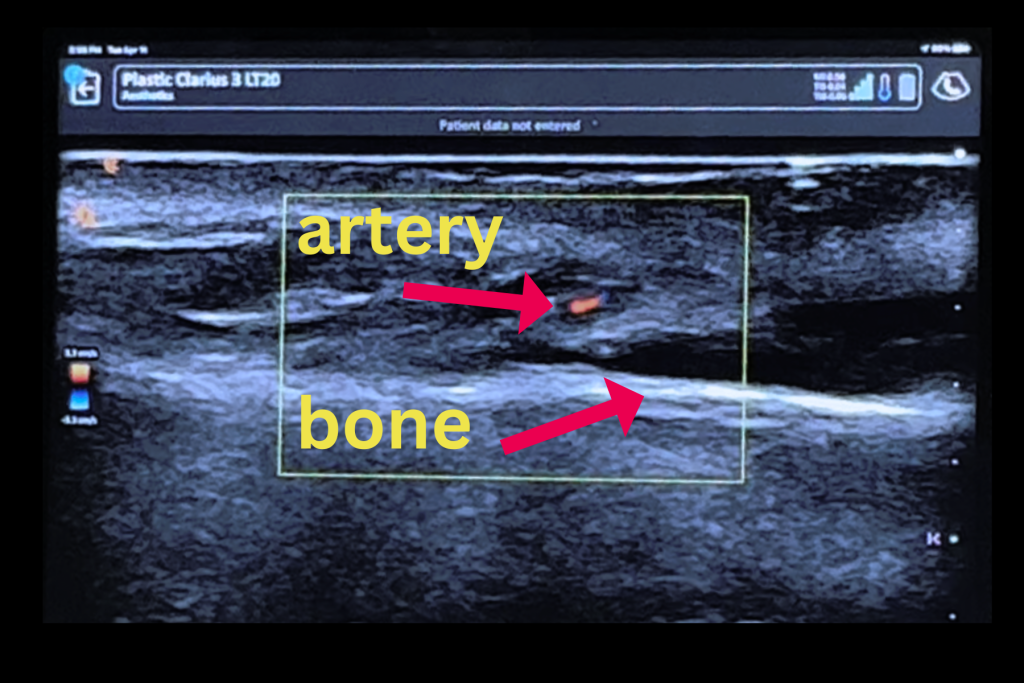 diagram of ultrasound showing the artery and the bone