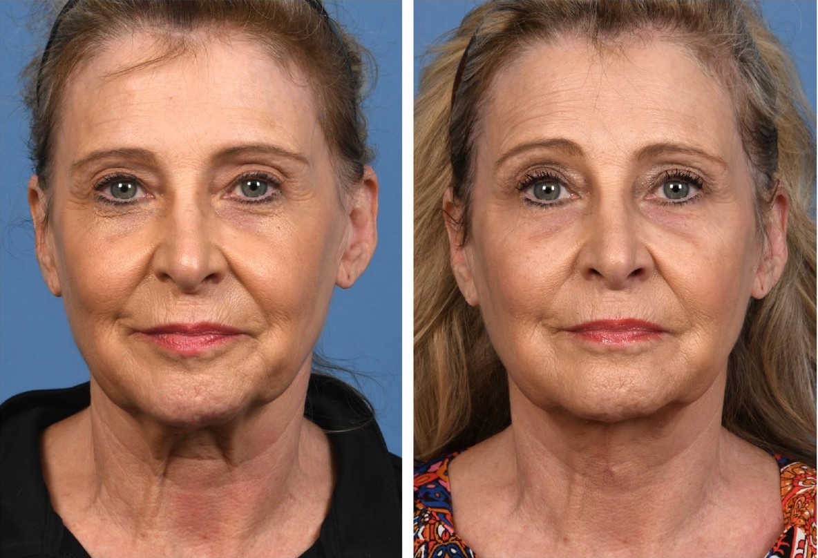 How Are Male Facelifts Different? Exploring Facial Rejuvenation Options ...