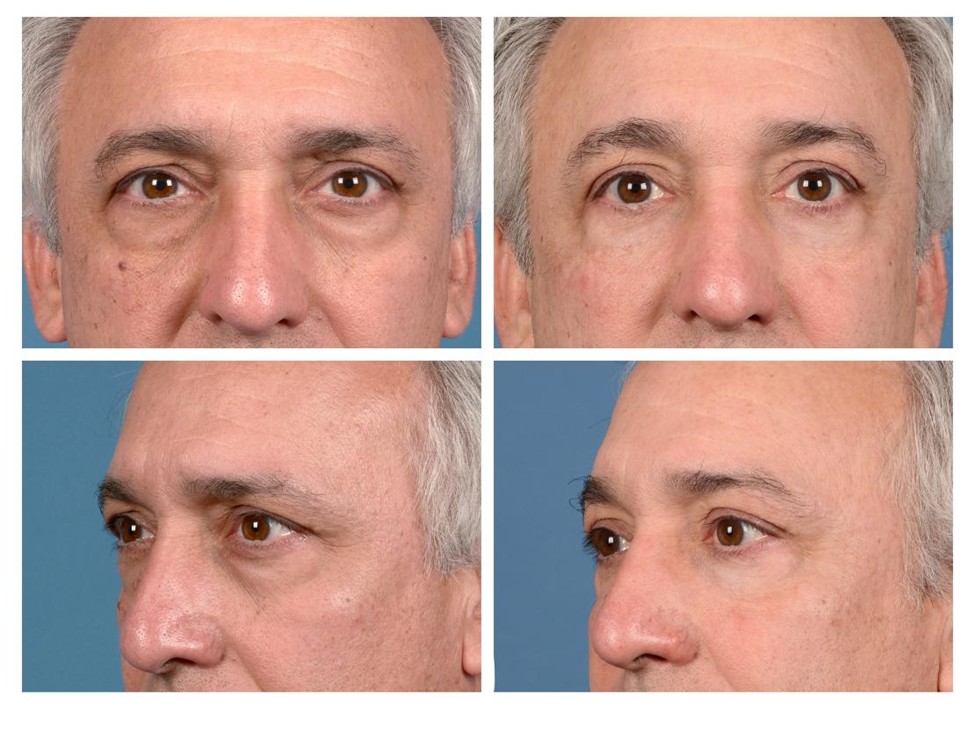 Real patient of Dr. Jeffrey Kenkel - before and one year after upper and lower eyelid surgery and fat grafting