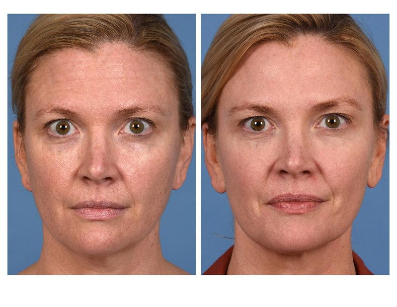 Real patient of Dr. Jeffrey Kenkel - This patient underwent skin care, intense pulsed light (IPL), and botulinum toxin injections.
