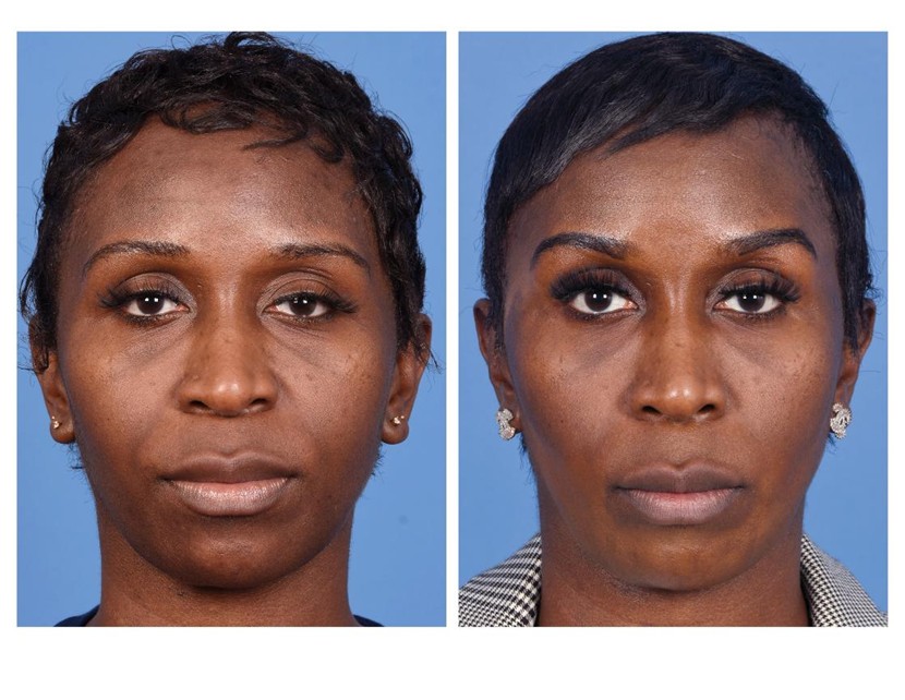 Real patient of Dr. Jeffrey Kenkel - This patient underwent filler injection to the medial tear trough.