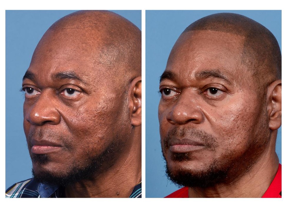 Real patient of Dr. Jeffrey Kenkel - This gentleman underwent a series of energy based microneedling to help with his acne scars and textural improvement of his skin.