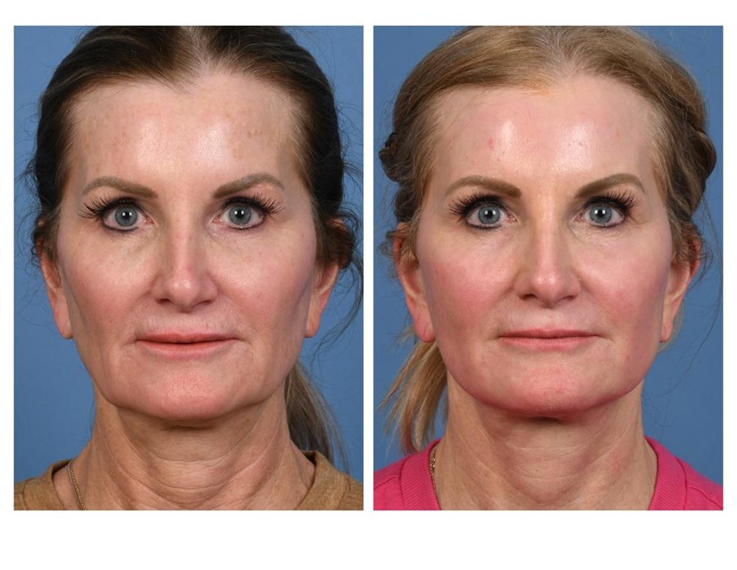 Real patient of Dr. Jeffrey Kenkel - this patient underwent facial rejuvenation - front view