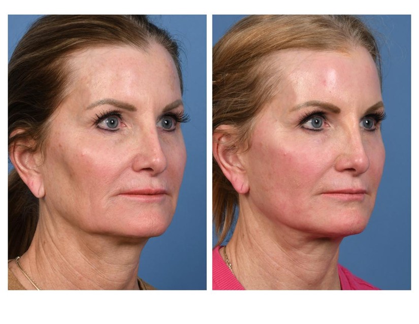 Real patient of Dr. Jeffrey Kenkel - this patient underwent facial rejuvenation - oblique view