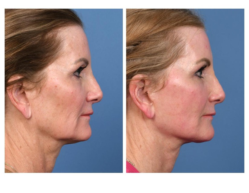 Real patient of Dr. Jeffrey Kenkel - this patient underwent facial rejuvenation - side view