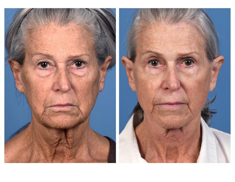 Real patient of Dr. Jeffrey Kenkel - This patient underwent upper and lower eyelid surgery, high SMAS facelift with erbium resurfacing shown here 9 months from her procedure. - front view