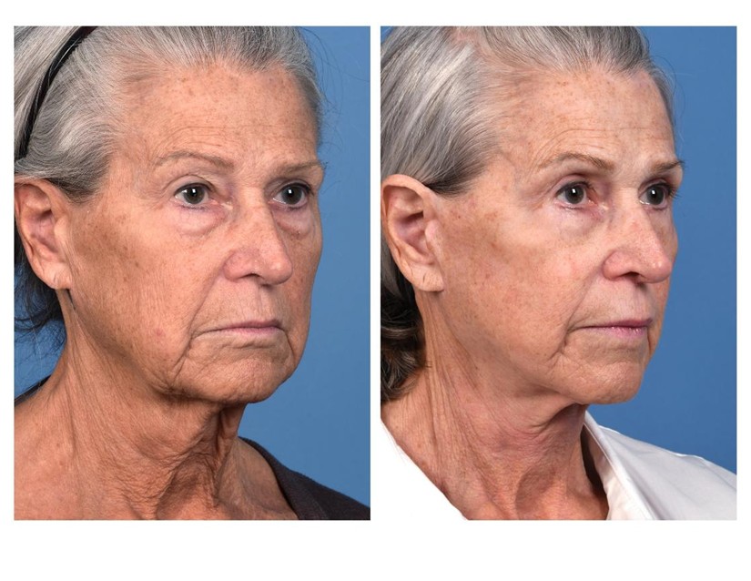 Real patient of Dr. Jeffrey Kenkel - This patient underwent upper and lower eyelid surgery, high SMAS facelift with erbium resurfacing shown here 9 months from her procedure. - oblique view