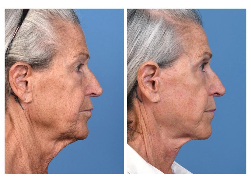 Real patient of Dr. Jeffrey Kenkel - This patient underwent upper and lower eyelid surgery, high SMAS facelift with erbium resurfacing shown here 9 months from her procedure. - side view