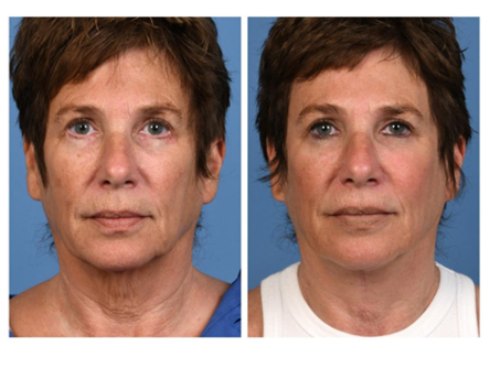 Before and After direct neck excision in Dallas by Dr. Jeffrey Kenkel