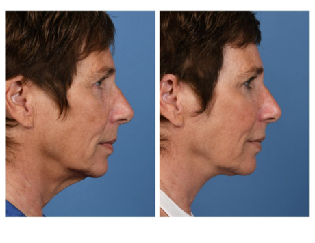 Before and After direct neck excision in Dallas by Dr. Jeffrey Kenkel (side view)