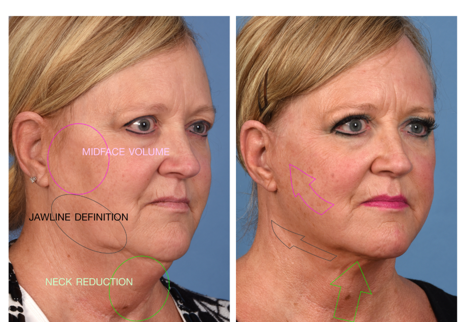 Lower facelift and neck lift before and after showing improved jawline definition, reduced neck fullness, and enhanced midface contour.
