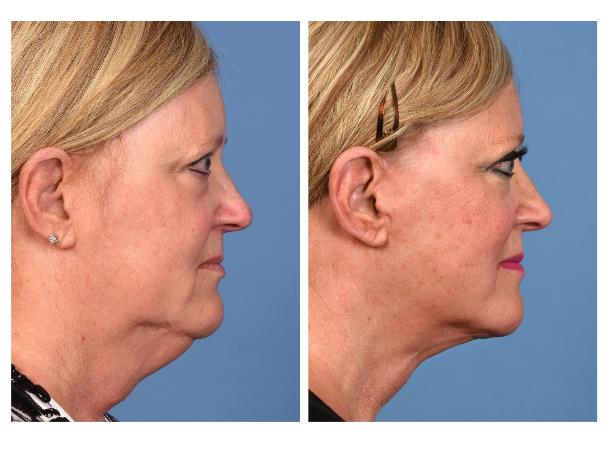 Real patient before-and-after photo