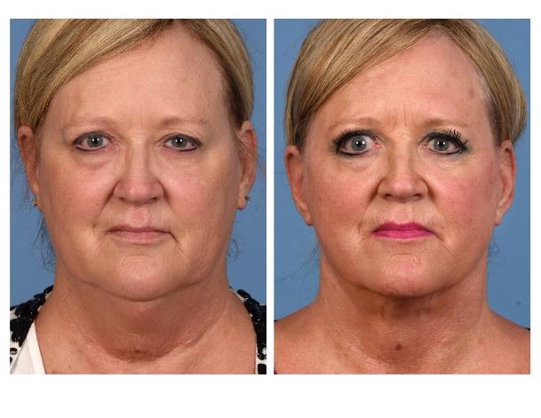 Real patient before-and-after photo